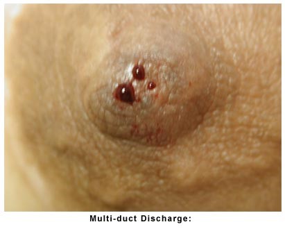 Nipple Discharge - Motamed Cancer Institute